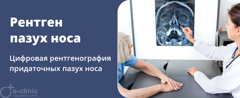 Рентген околоносовых пазух носа Рентген околоносовых пазух носа