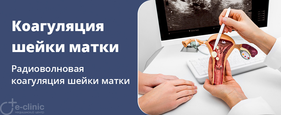 Радиоволновая коагуляция шейки матки Радиоволновая коагуляция шейки матки